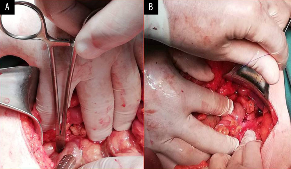 Intraoperative findings. (A) After extensive Kocher maneuver, we demonstrate the presence of the perforation at the superior part of the duodenum. (B) The application of sutures (type: monofilament absorbable, size: 3-0) at the site of the leakage.