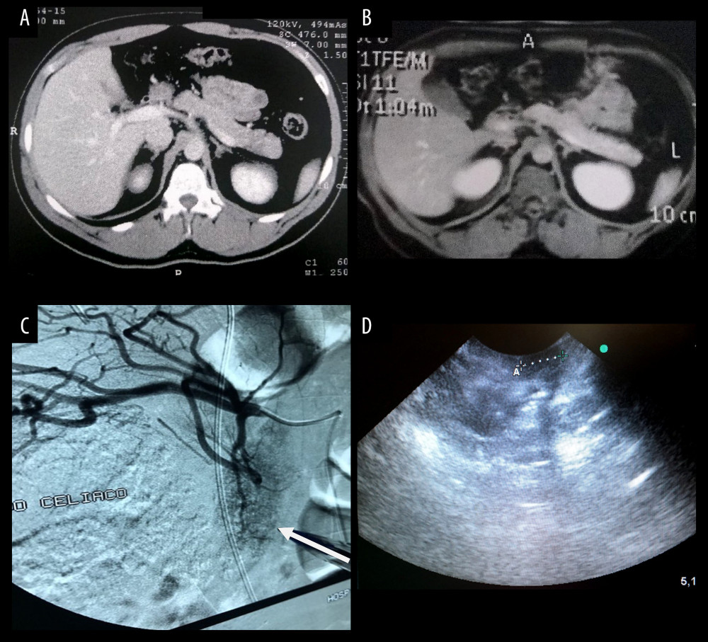 Image exams for localization. (A) Abdominal CT scan; (B) Abdominal magnetic resonance image; (C) Arteriography showing niche of hypervascularization (arrow); (D) Intraoperative ultrasound showing small nodule in pancreas tail.