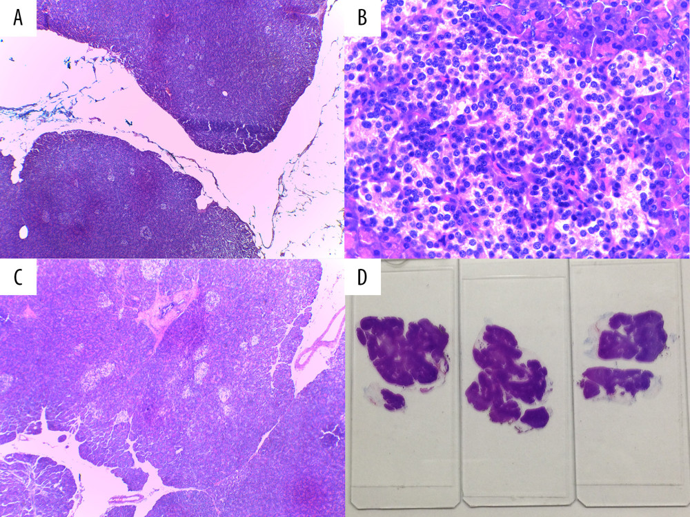 Histopathologic images of pancreas. (A) Hyperlobulated pancreas with an increased number of Langerhans islets (hematoxylin/eosin, 50×); (B) Hyperplastic Langerhans islets (hematoxylin/eosin, 400×); (C) Hypertrophic and hyperplastic Langerhans islets (hematoxylin/eosin, 100×); (D) Pancreatic tissue with heterotopic nodules.