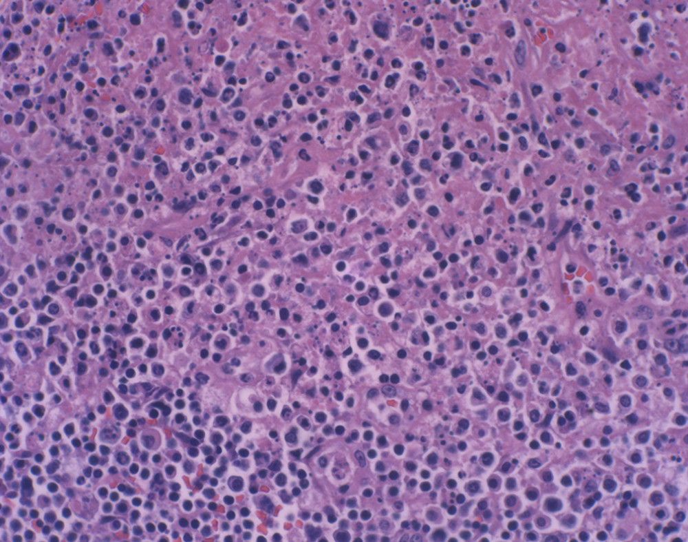 Close-up magnification of the H&E stains of the patient’s cervical lymph nodes showing the characteristic features of histiocytic necrotizing lymphadenitis. The well-defined necrotic area includes histiocytic infiltrate with karyorrhectic debris and the notable lack of neutrophils.
