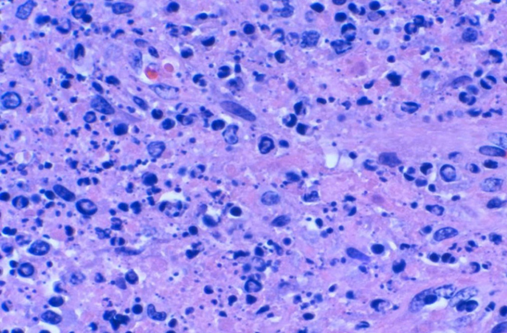 Higher magnification of the H&E stains showing crescentic histiocytes.