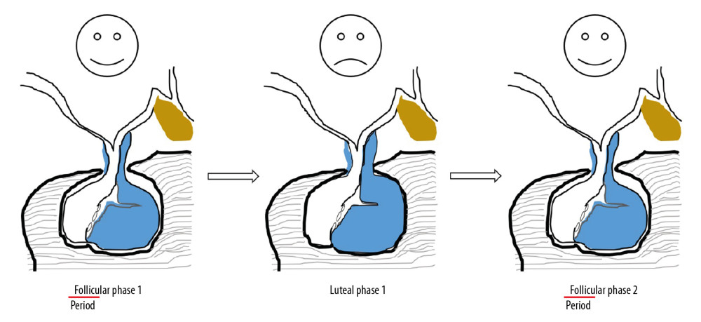 A proposed pathophysiological model for cyclic PMS/PMDD symptoms. The size of a normal functional pituitary gland changes during each menstrual cycle, but the extent of the change is limited or restricted by a NFPA (lesion is not drawn in the figure) or other types of space-occupying lesions. A distorted gland body or its stalk may reduce or even block the action of neurotransmitter(s) that originate from the hypothalamus or other anatomical connections. PMS/PMDD symptoms occur due to a delicate imbalance within the brain. When the size of the pituitary gland returns to baseline during the follicular phase, PMS/PMDD symptoms are also resolved while neurotransmitter transport is restored.