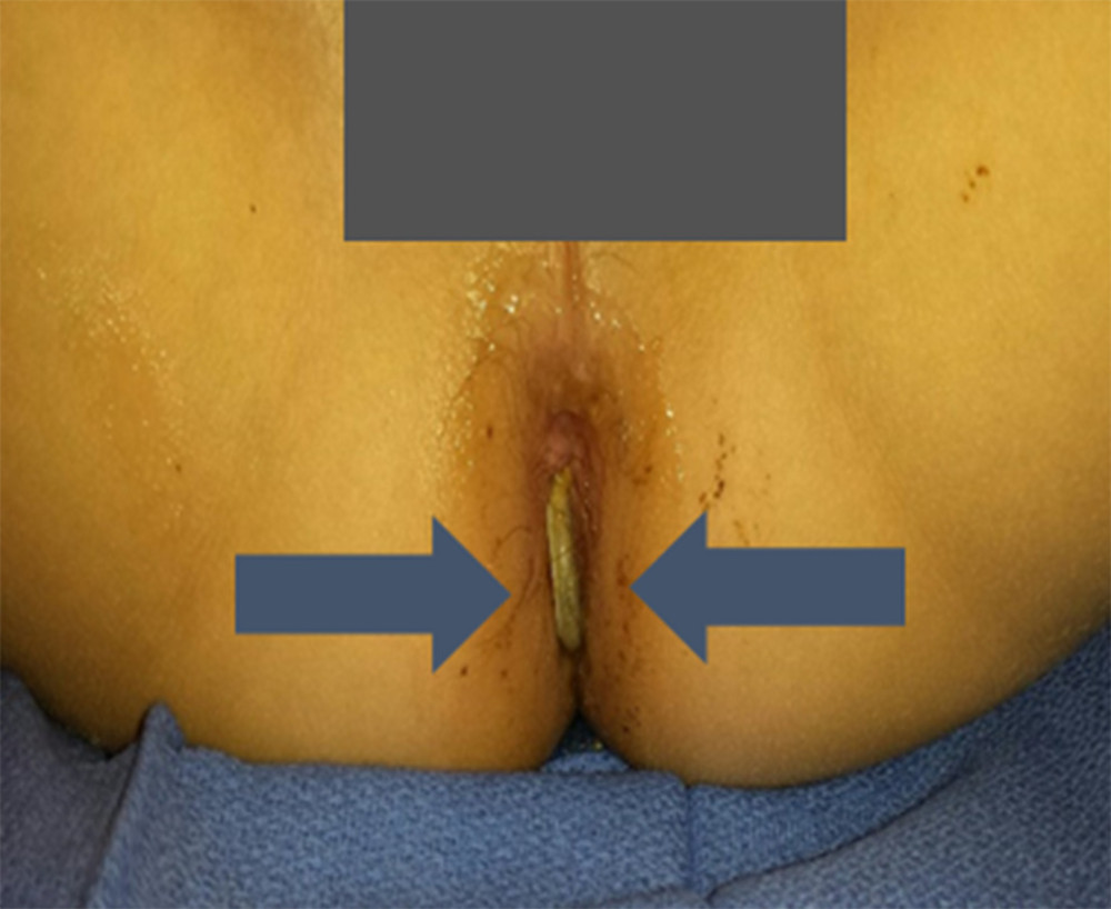 PD catheter protruding through anus on exam (arrows).