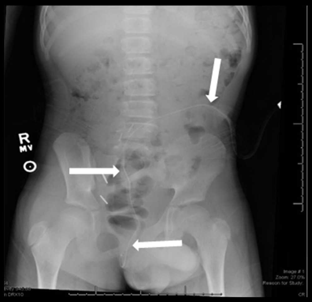 Abdominal X-ray anteroposterior view showing PD catheter with the tip projecting over the perineum (arrows).