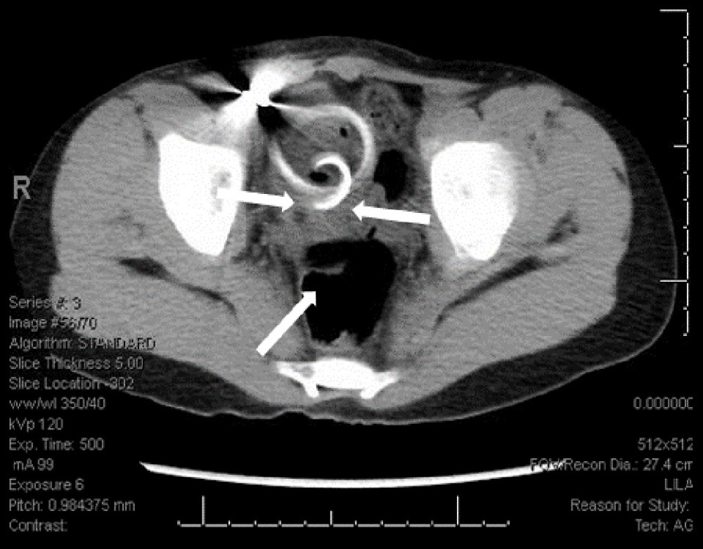 Abdominal CT scan transverse view showing the entry of PD catheter in sigmoid colon (arrows).