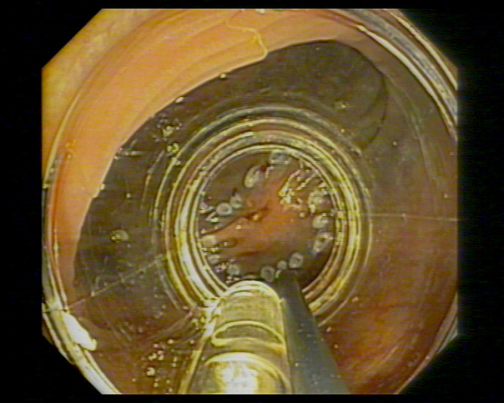 Endoscopic full thickness resection of the lateral spreading tumor using over-the-scope clip device.