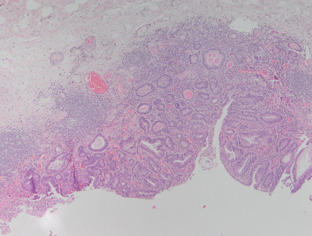 Adenomatous polyp showed an area of intramucosal carcinoma/high-grade dysplasia with involvement of the muscularis mucosae. (hematoxylin and eosin, 4×).