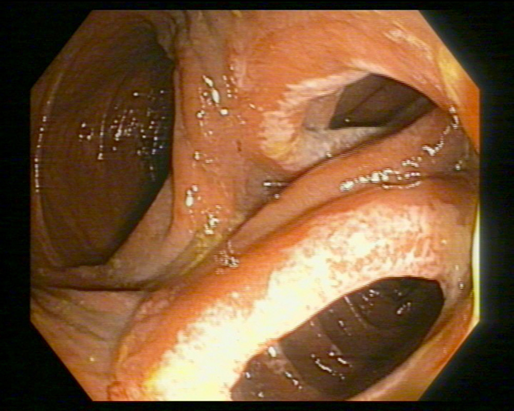 The orifice of entero-colonic fistula and remaining hyperemic colonic mucosa with erosions and superficial ulcerations.