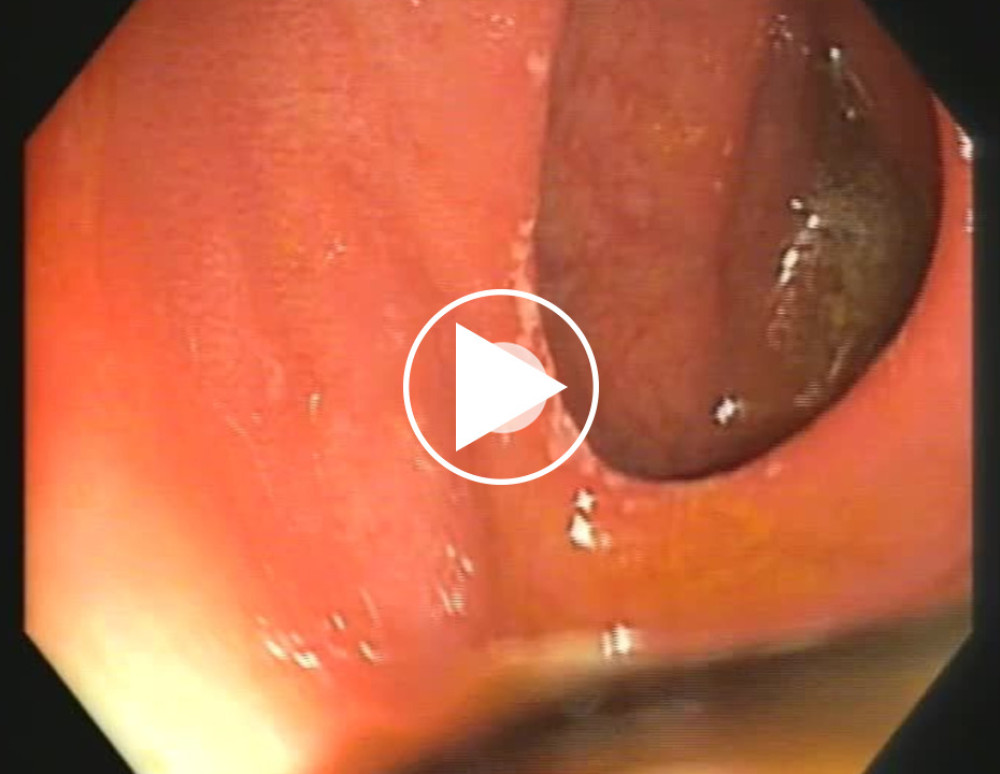 The video shows the orifice of entero-colonic fistula with hyperemic mucosa.