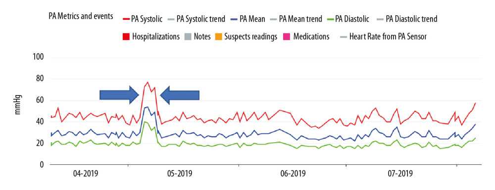 PA systolic, mean, and diastolic pressures from 04/2019 to 07/2019. Large blue arrows show elevation of all pressures during time of travel to high altitude.