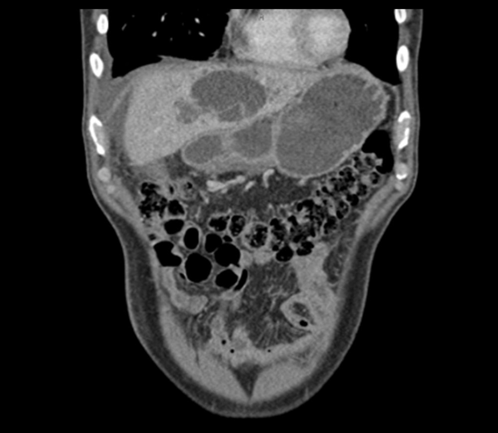 Computed tomography (coronal projection) depicting a 6-cm, ampulla-like, cystic-appearing hypodense left hepatic lobe lesion with bile duct and periampullary thickening resulting in mass effect and consequent duodenal stenosis.