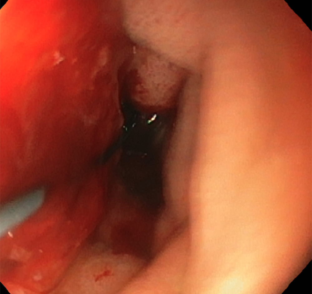 Esophagogastroduodenoscopy revealing a large, friable, and obstructing ulcerated mass lesion involving the major duodenal papilla.
