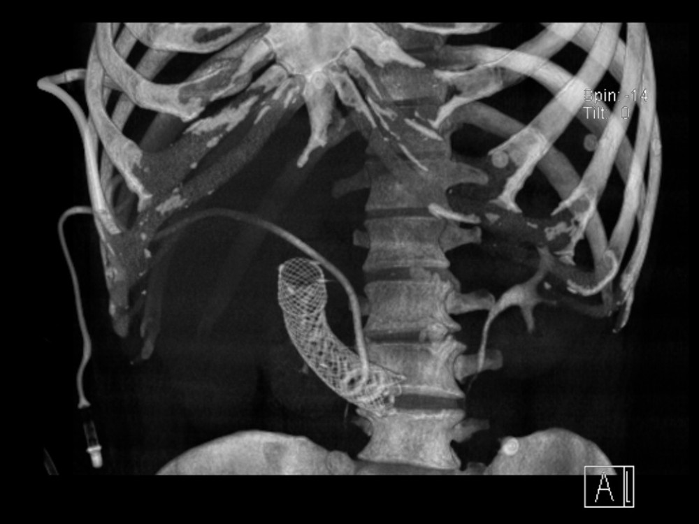 Computed tomography 3-D reconstruction demonstrating successful placement of a duodenal stent with a percutaneous transhepatic pigtail biliary drain coiled within it.