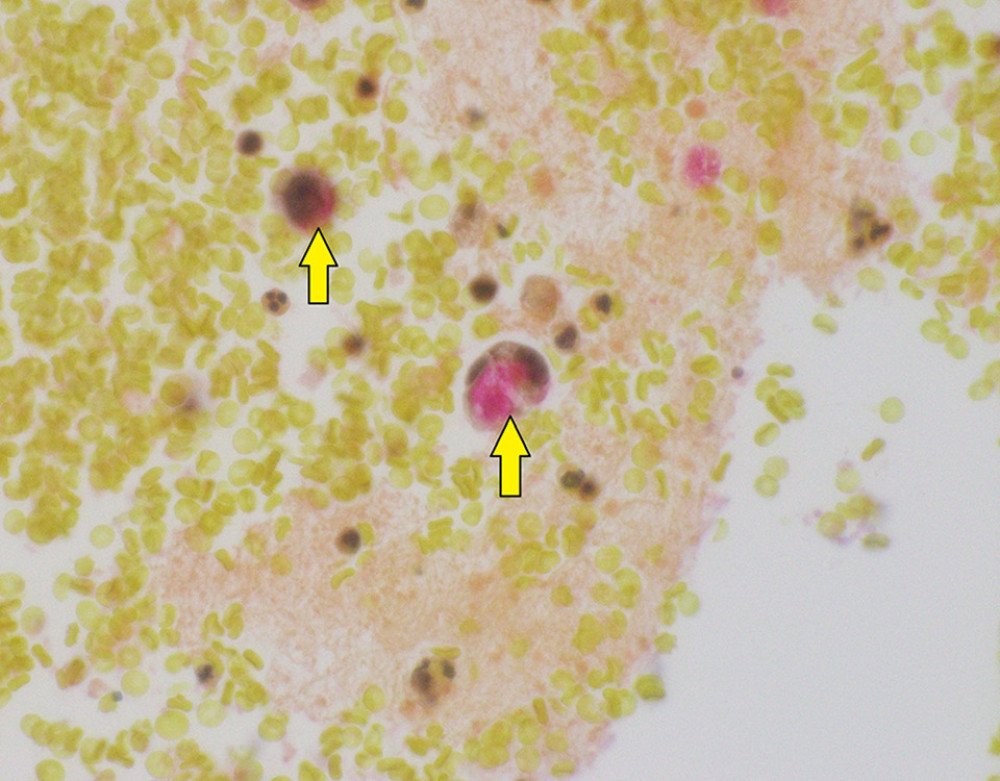 Malignant cells contained intracellular mucin on mucicarmine special stain (arrow) and were also immunoreactive to BerEP4 (not shown in the image), overall consistent with adenocarcinoma with signet ring features.