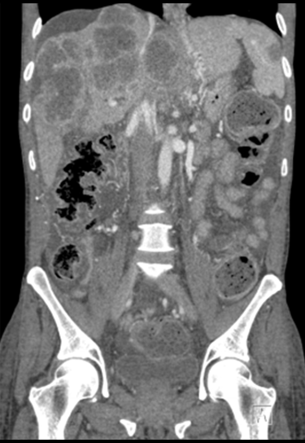 Computed tomography (coronal projection) scan of the abdomen and pelvis demonstrating liver metastases radiographically resembling a sigmoid colon, illustrating the concept of homomorphism.