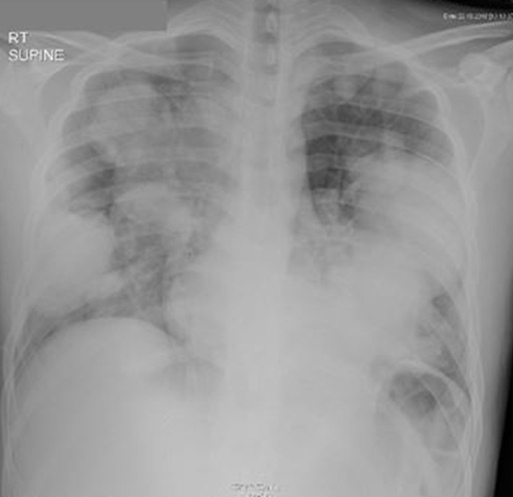 Chest x-ray shows bilateral cannon-ball lesions suggestive of metastasis.