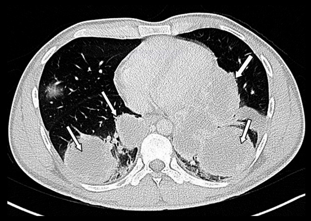 CT scan of the chest shows multiple large bilateral lung masses as seen by the white arrows.