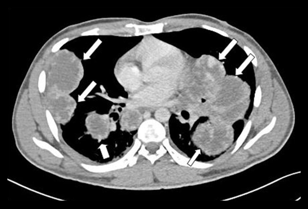 Chest CT mediastinal window shows large masses (white arrows) in both lungs and severe compression of the superior vena cava.
