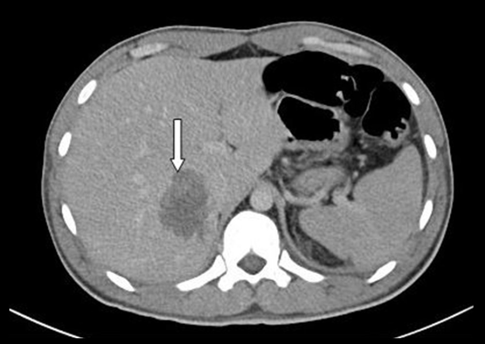 Abdominal CT shows a large hypodense hepatic lesion (white arrow) measuring 3.4×2.3 cm involving segment VII suggestive of metastasis.