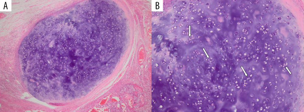 Teratomatous component of the testicular biopsy showing hypercellular chondrocytes consistent with grade I chondrosarcoma (A). A high-power image of the chondrosarcoma which demonstrates chondrocytes (white arrows) is also seen (B).