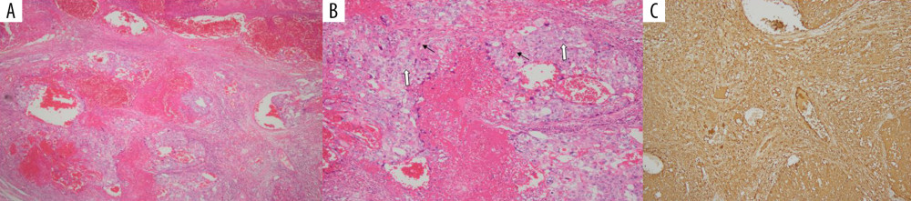 Choriocarcinoma component of the mixed germ cell tumor (A) showing admixture of polygonal cells with clear cytoplasm (cytotrophoblast, white arrows) and large multinucleated cells with smudged nuclear chromatin (syncytiotrophoblast, black arrows) on high-power field (B). Immunohistochemistry stains displayed strong positivity with B-HCG (C).