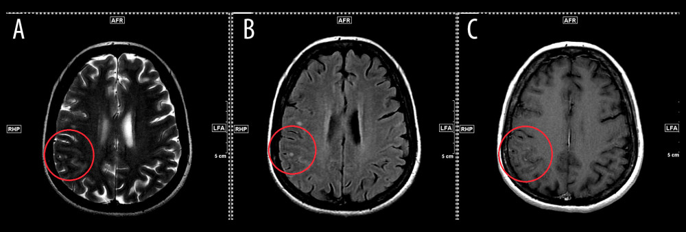 Composite radiological images of MRI of the brain (A: Axial T2 FSE, B: FLAIR, and C: T1 post Gadolinium) at first CNS relapse in June 2010. Abnormal signal intensities were observed within the swollen cortical and subcortical regions in the right posterior parietal location, along with subtle leptomeningeal enhancement highly suggestive of leptomeningeal infiltration in the context of leukemia (red circles).