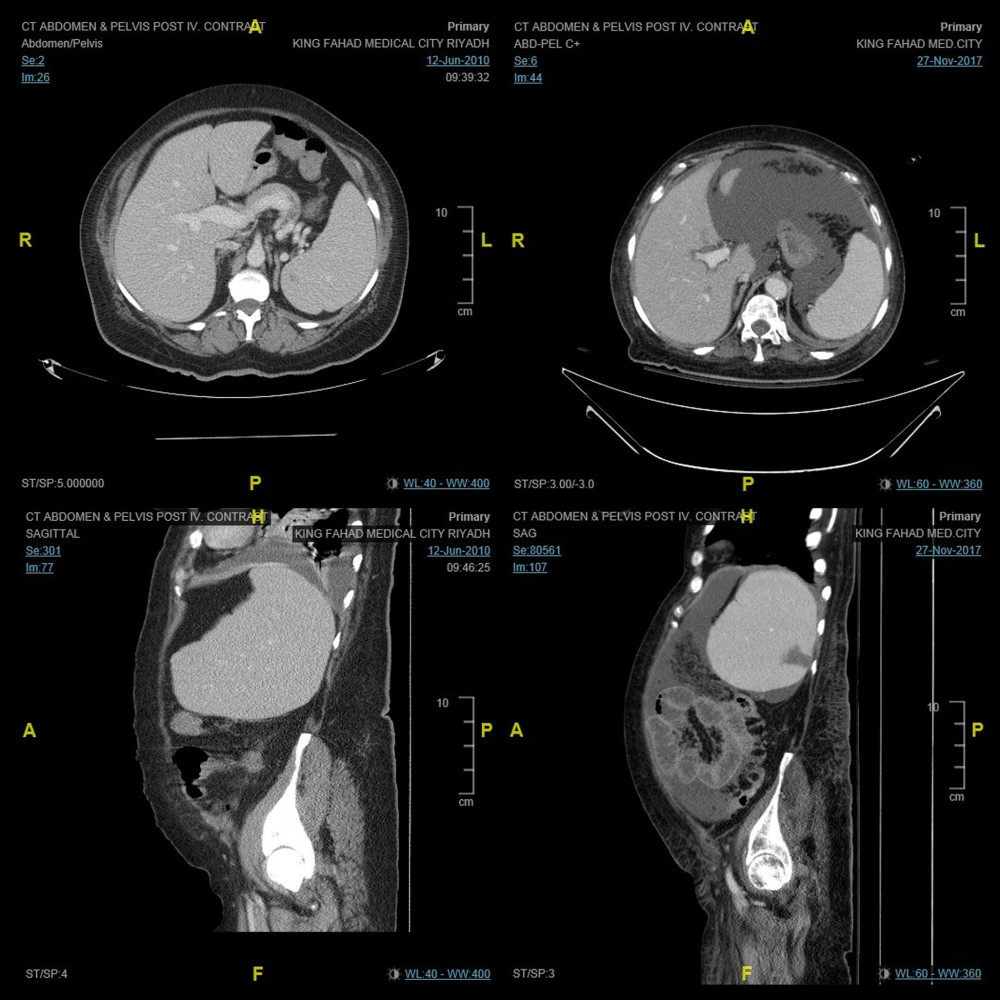 Composite radiological images comparing abdomen and pelvic CT scans at the time of diagnosis in June 2010 (left) and 7 years later in November 2017 when the patient was in treatment-free remission (right), showing the disappearance over time of splenomegaly.