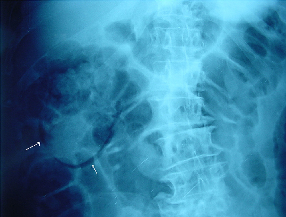 Plain X-ray showing air present peripheral to the right kidney (arrows).