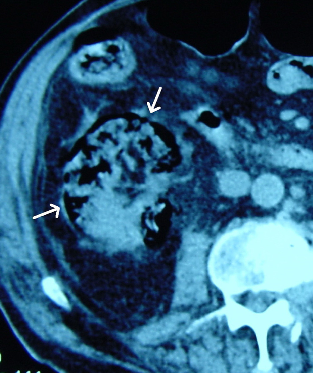 Abdominal CT scan showing air inside and peripheral to the right kidney (arrows) and nephrolithiasis.