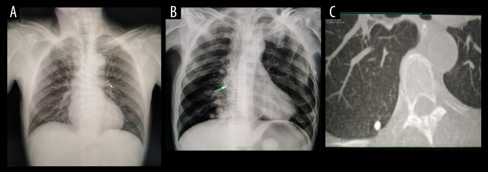 (A) Initial chest x-ray normal. (B) Chest x-ray and (C) computed tomography scan at 19 days later in which a unique nodular image is observed.