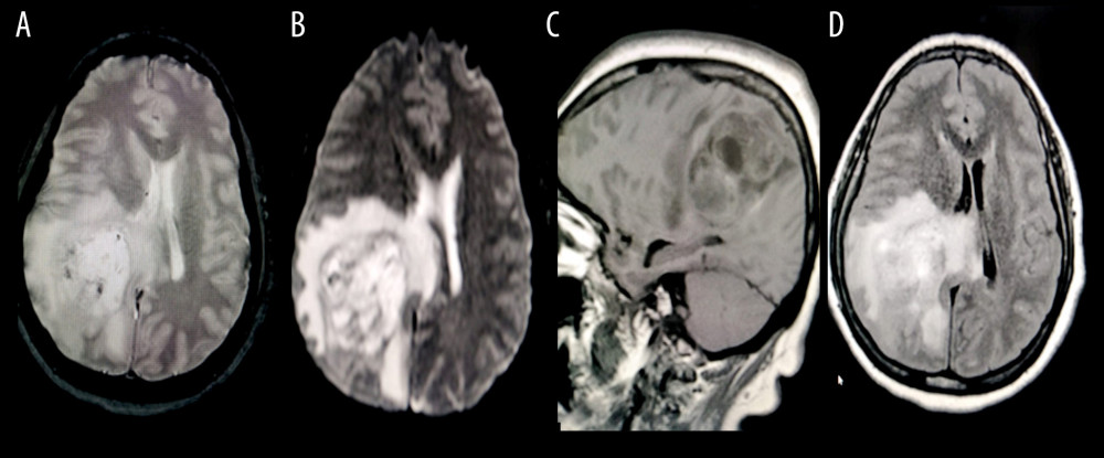 The magnetic resonance (MRI) in sequence T1. (A) Showed an occupation zone of hererogenic intensity, with halo hypointense, which is compressing adjacent areas. (B) MRI in Gradient Sequence Eco was observed an occupation mass with apparent vascularization that compresses callous rodent and displaces adjacent structures and hyperintense image. (C) MRI in Flair sequence, an occupational lesion was observed that is performing mass effect, compressing adjacent areas, which is surrounded by a hyperintense halo that reaches to the cerebral cortex. (D) MRI in Diffusion image restriction of water diffusion was observed, generating a central heterogeneous zone surrounded by a hyperintense halo.