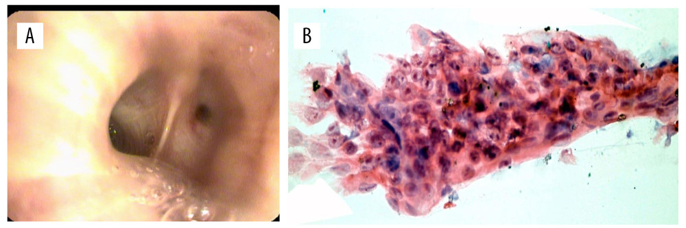 (A) Showed an exploratory bronchoscopy revealed the presence of thickening of the mucosa and areas consistent with anthracosis protrusion area partially obstructing the bronchial lumen and (B) dense cellularity of round, ovoid and elongated elements, with signs of anaplasia evidenced by macronucleosis, nucleolar prominence, altered polarity and nucleo-cytoplasm relationship possibly corresponding to metastatic spread of brain neoplasia.