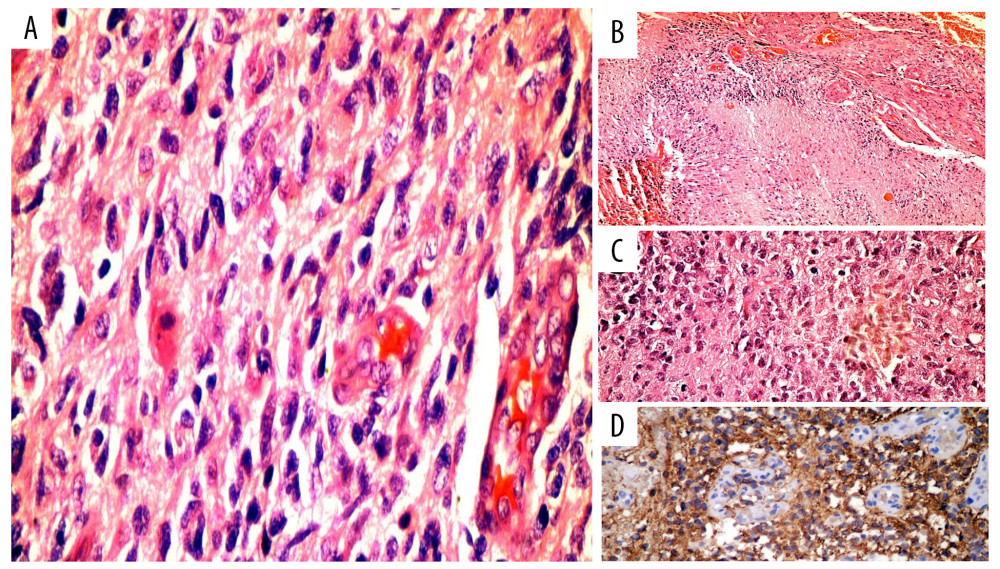 (A) Showed histological sections reveal densely cellular neoplasia consisting of polygonal ovoid round cells and fusiform with signs of anaplasia evidenced by macronucleosis, hyperchromatism, pleomorphism, and intense mitotic activity (>25×10) with alteration of the polarity and the nucleus-cytoplasm relationship. (B, C) Showed areas of necrosis surrounded by viable tumor cell palisades, as well as proliferation of glomeruloid vessels of swollen endothelium, typical of high-grade gliomas. (D) Showed immuno-staining for glial fibrillary acidic protein (GFAP) is intensely positive in tumor cells and verifies their glial lineage.