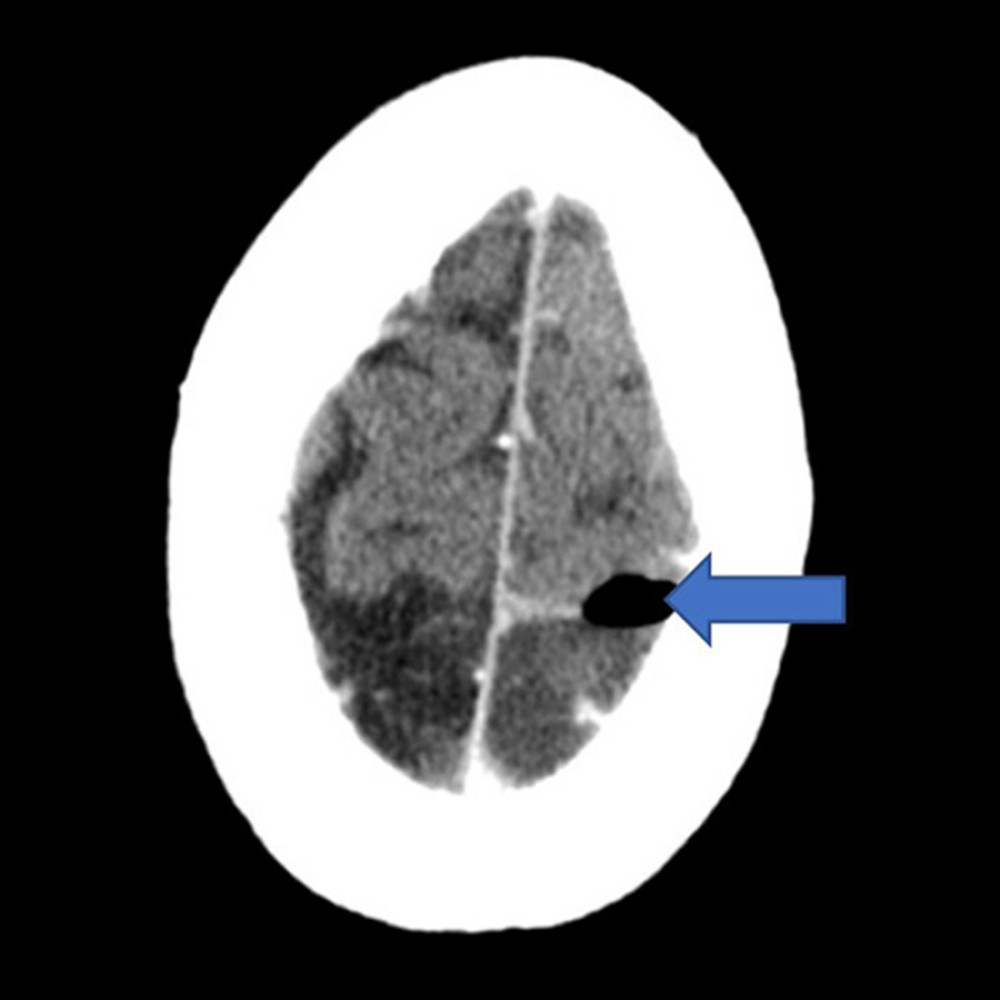 CT head: blue arrow demonstrating pneumocephalus.