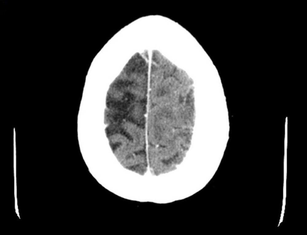 CT head demonstrating complete resolution of pneumocephalus.