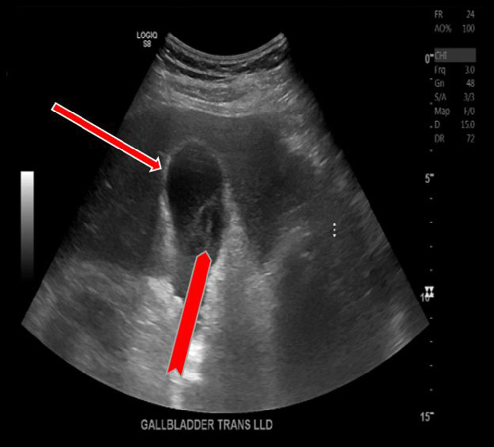 Sagittal view of a distended gallbladder with 2.54 mm thickening of gallbladder wall (thin arrow) and gallstone (thick arrow).