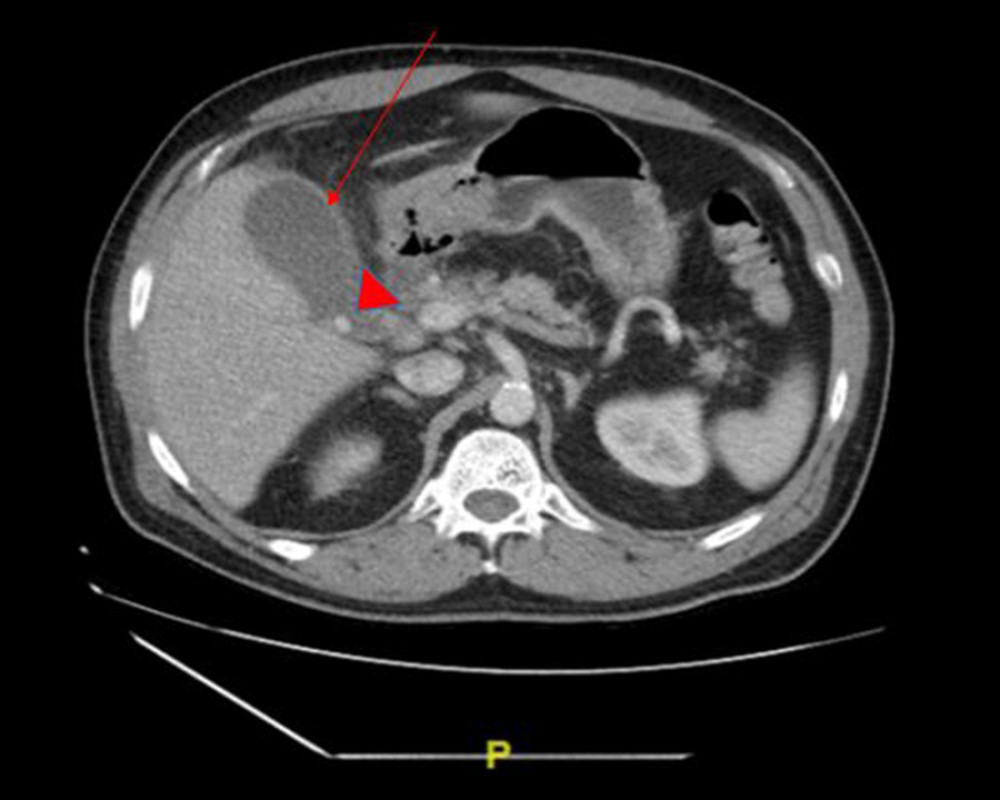 CT-Abdomen showing findings consistent with acute cholecystitis, including mild thickening of the gallbladder wall (arrow) and cholelithiasis (arrowhead).