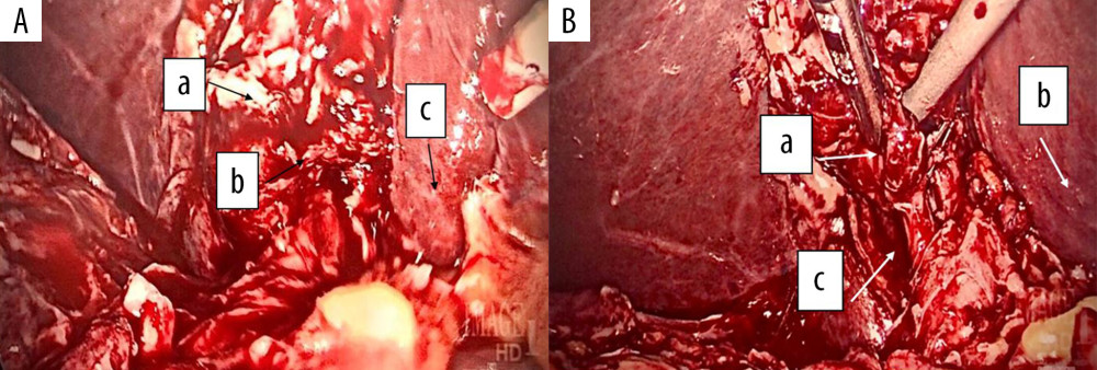 (A) Laparoscopic imaging of the gallbladder showing suppurative inflammation and unrecognizable views/anatomy of the gallbladder. Gallbladder infundibulum (a), medial edge of liver (b), cystic duct (c). (B). Laparoscopic imaging of the gallbladder showing suppurative inflammation and unrecognizable views of the gallbladder. Pus (a), distorted gallbladder anatomy (b), medial edge of liver (c).