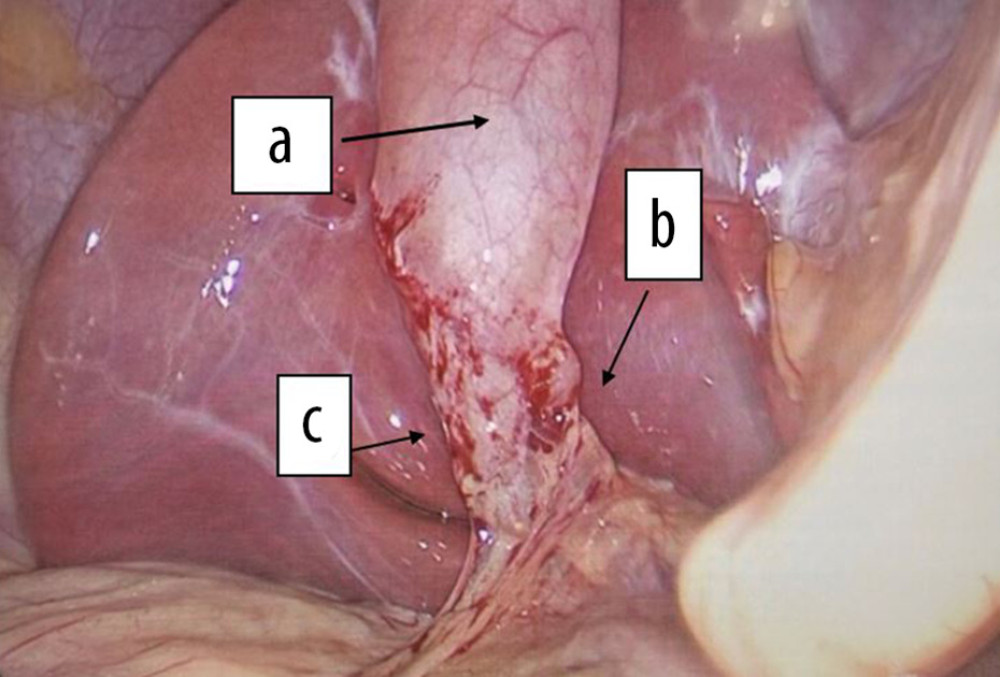 Laparoscopic imaging of commonly appearing gallbladder acute cholecystitis. Gallbladder body (a), cystic artery (b), medial edge of liver (c).