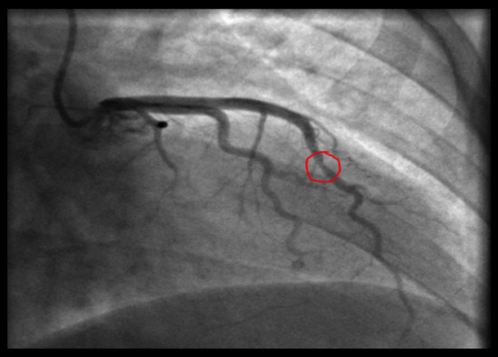 Coronary angiography of our patient, demonstrating compression of the left anterior descending artery during systole (red circle).