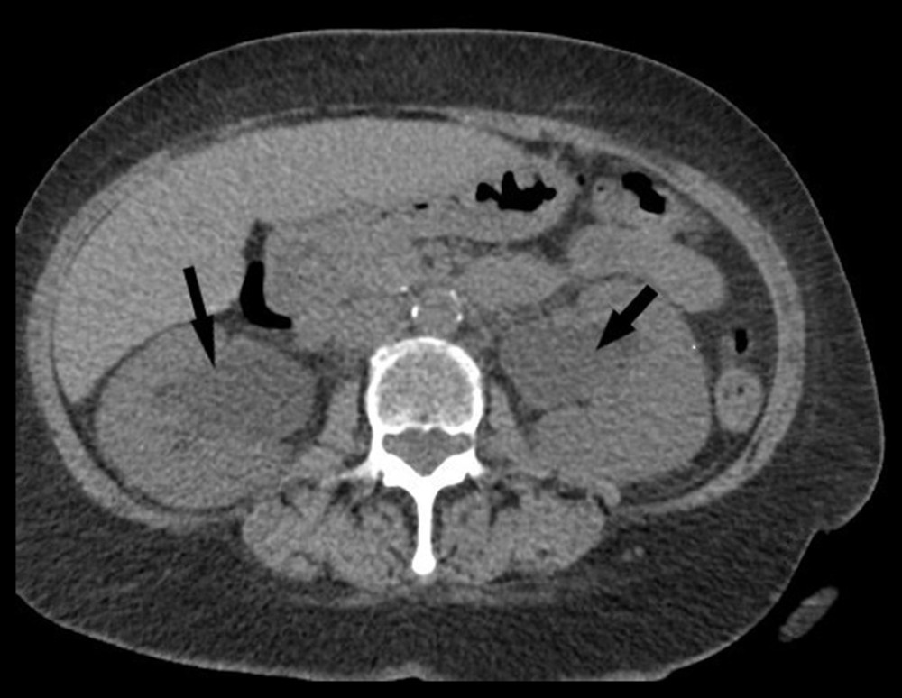Computed tomography scan of abdomen and pelvis showing bilateral hydronephrosis (arrows).