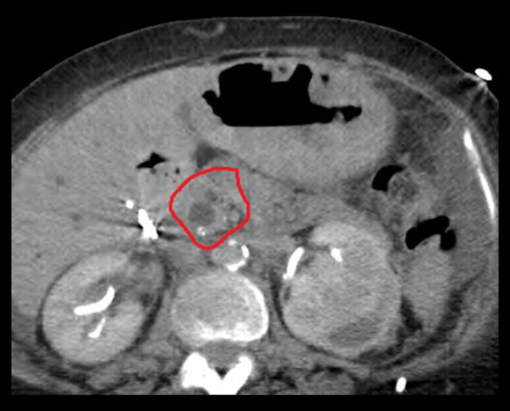 Computed tomography scan of the abdomen showing dilated common bile duct and pancreatic ducts, “double-duct” sign (circle).