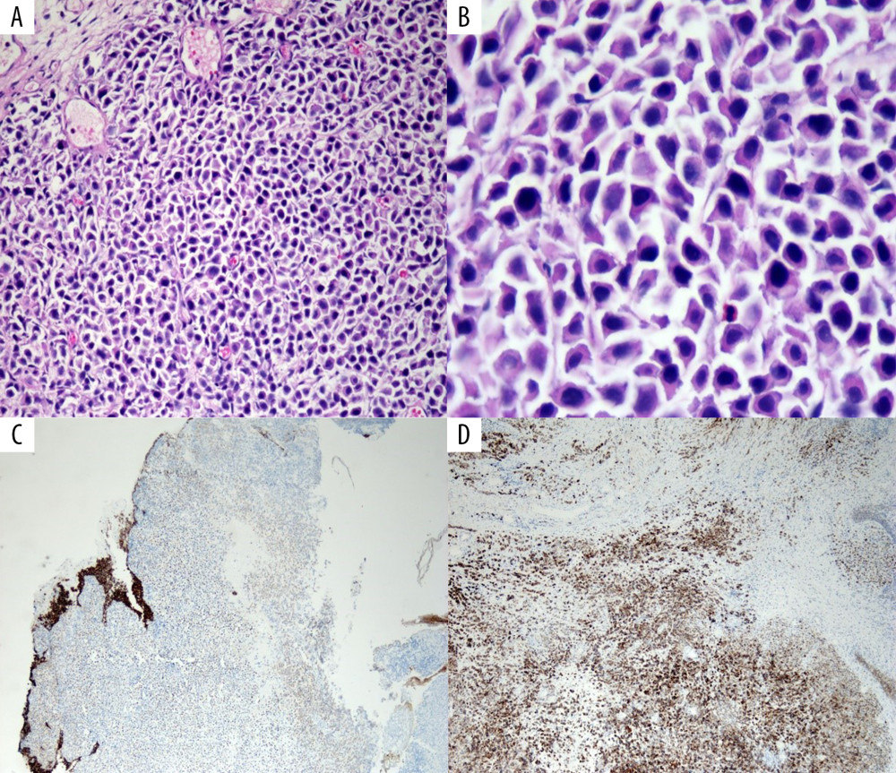 (A) Low power hematoxylin and eosin stain showing sheets of tumor cells. (B) High power hematoxylin and eosin stain showing discohesive plasmacytoid tumor cells with eccentric nuclei and round contour. (C) E-cadherin stain showing tumor cells with loss of E-cadherin. (D) CD138 satin showing tumor cells positive for CD138.