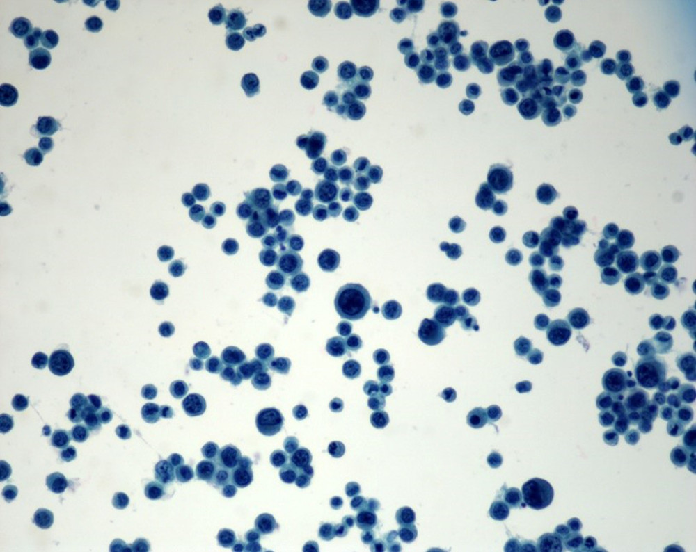Ascitic fluid cytology showing sheets of plasmacytoid tumor cells.