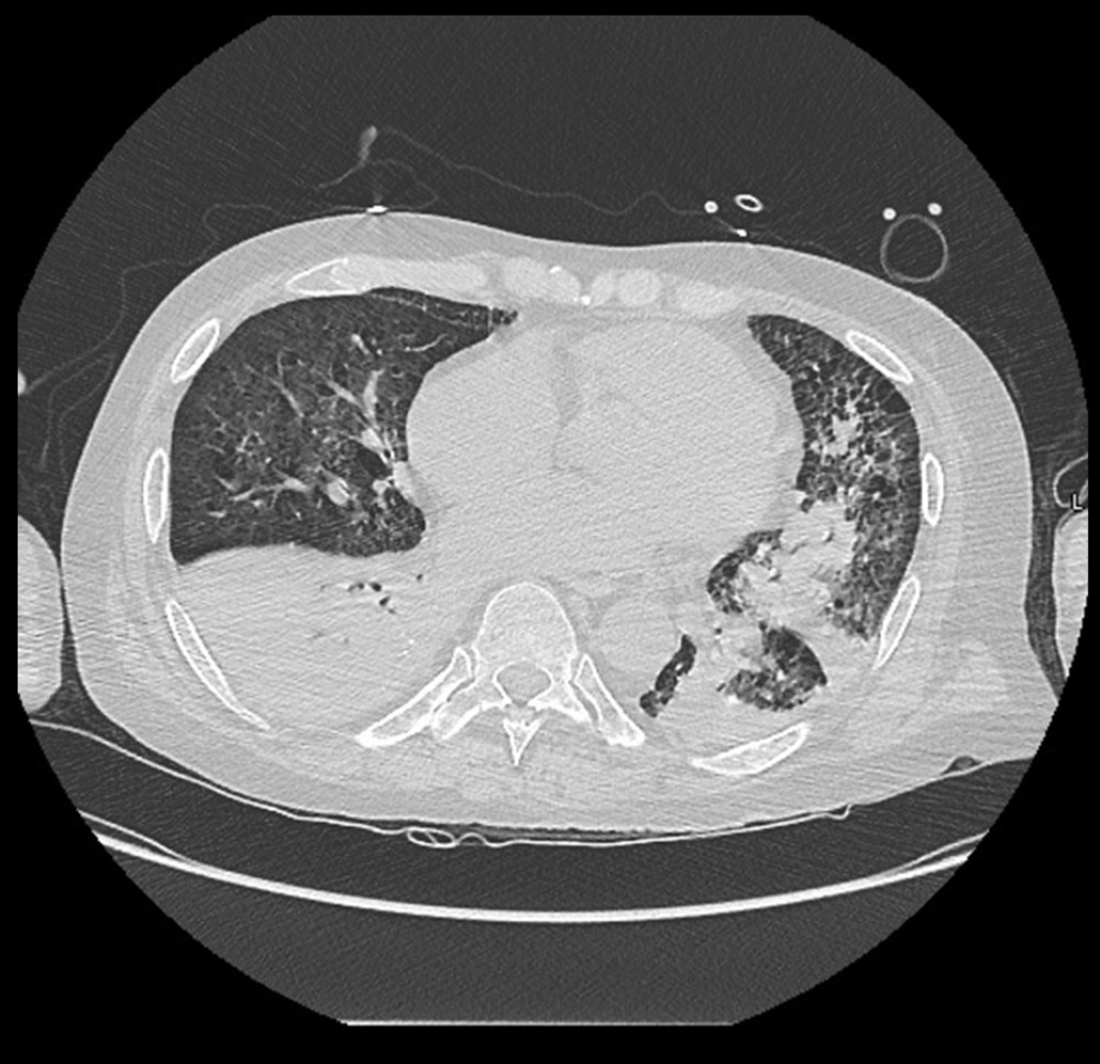 CT chest showing diffuse bilateral interstitial opacities and multifocal consolidation.