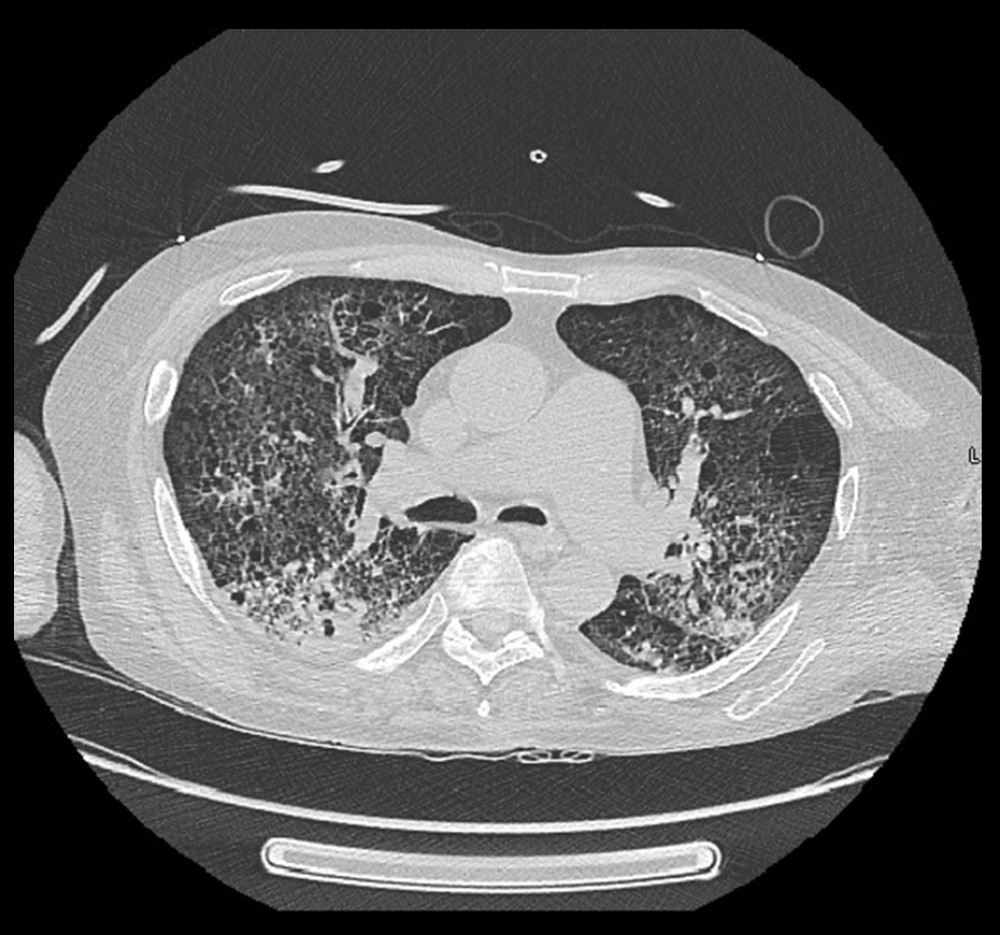 CT chest showing consolidation in multiple area and pulmonary hypertension.