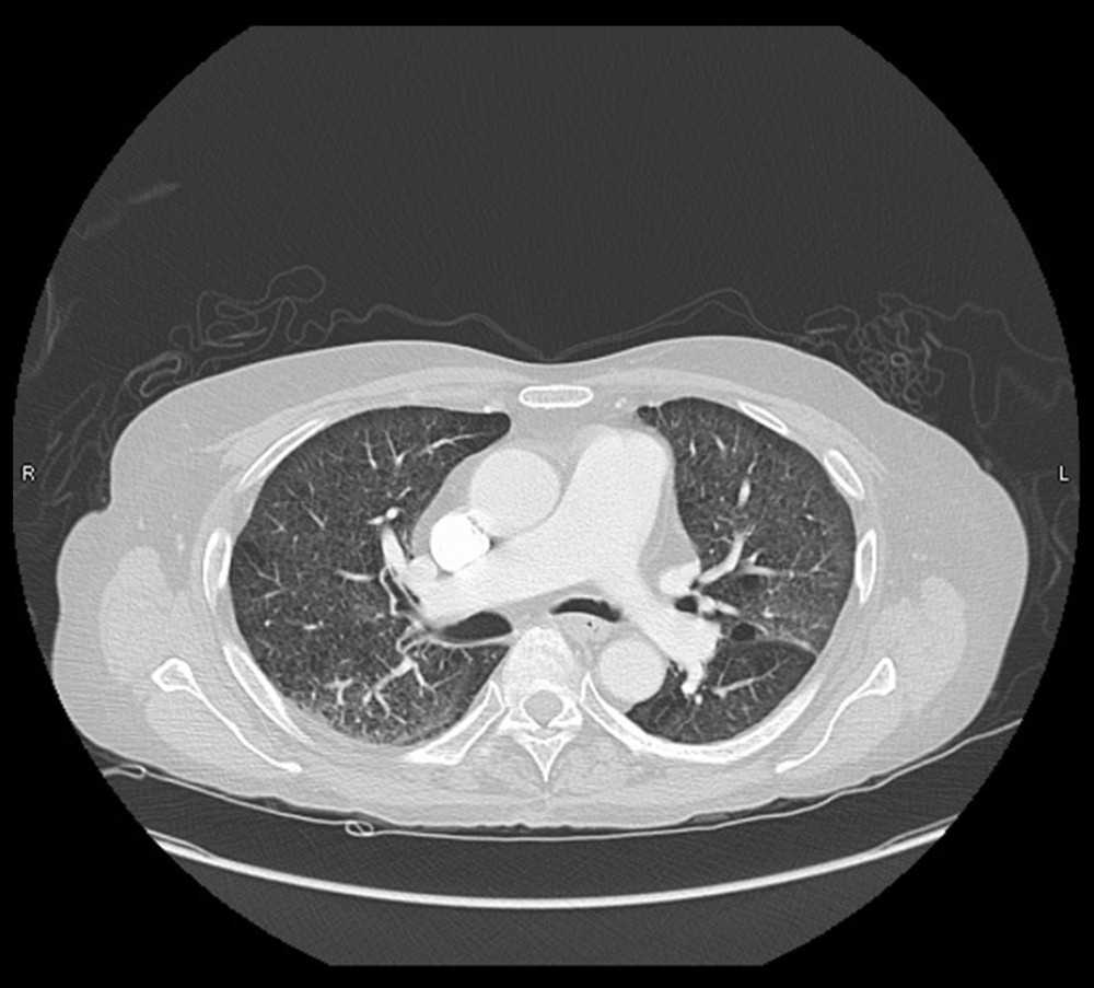 CT chest 30 days after treatment showing significantly decreased bilateral interstitial opacities.