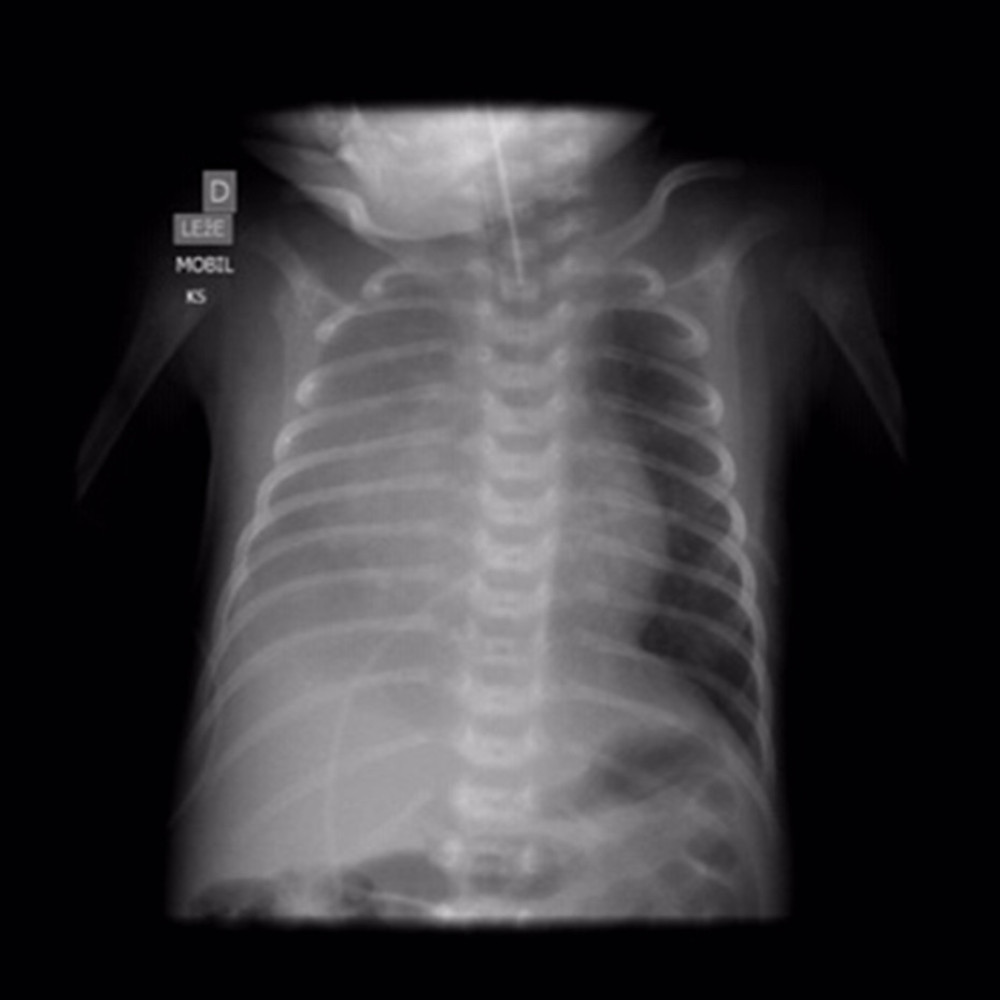 Chest X-ray showing cardiomegaly, displacement of the heart to the right, and relative right lung hypoplasia with abnormal opacity.