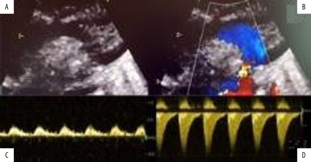 Echocardiogram of the aortic arch before surgery. (A) Narrowing of the aortic isthmus. (B) Turbulent flow. (C) Coarctation flow pattern on pulsed-wave Doppler. (D) Continuous-wave Doppler with diastolic runoff.