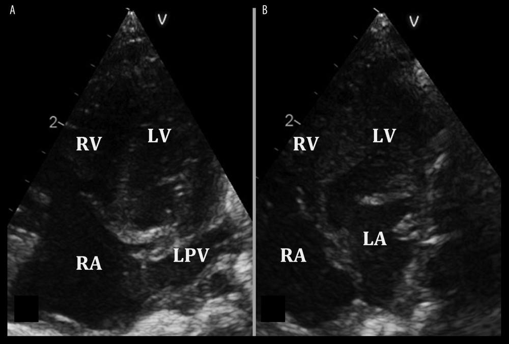 Echocardiographic 4-chamber view. (A) Displacement of the communication between the left pulmonary veins (LPV) and left atrium. (B) The relationship between the left atrium (LA) and the left ventricle (LV). There is no communication between the right pulmonary veins and the left atrium. RA – right atrium, RV – right ventricle.